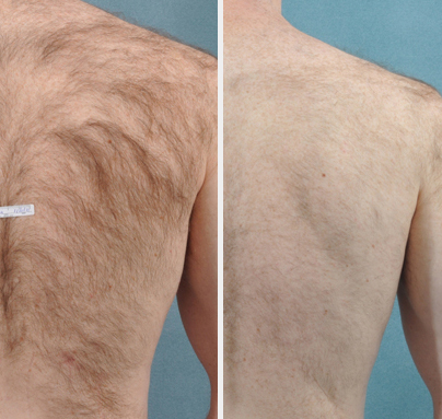 Photos courtesy of Sean Doherty, MD Boston Plastic Surgery Associates, Concord, MA Co-Medical Director, Palomar Medical Technologies, Inc., Burlington, MA